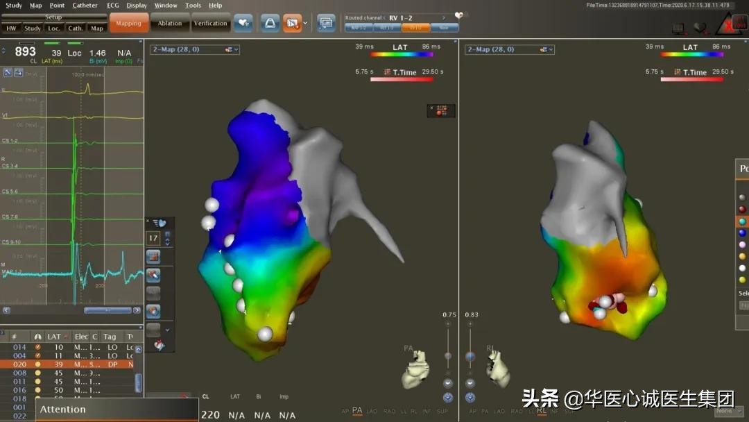 窦性心动过速查房,攀钢集团总医院心内科