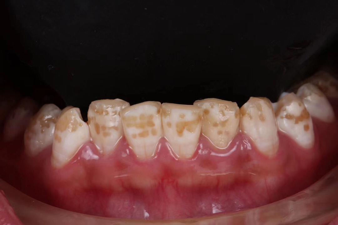 14岁牙齿黄可以洗牙变白吗,牙齿出血发黄去洗牙