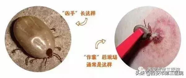 虫咬性皮炎很痒怎么治疗小偏方,恼人的皮炎怎么治