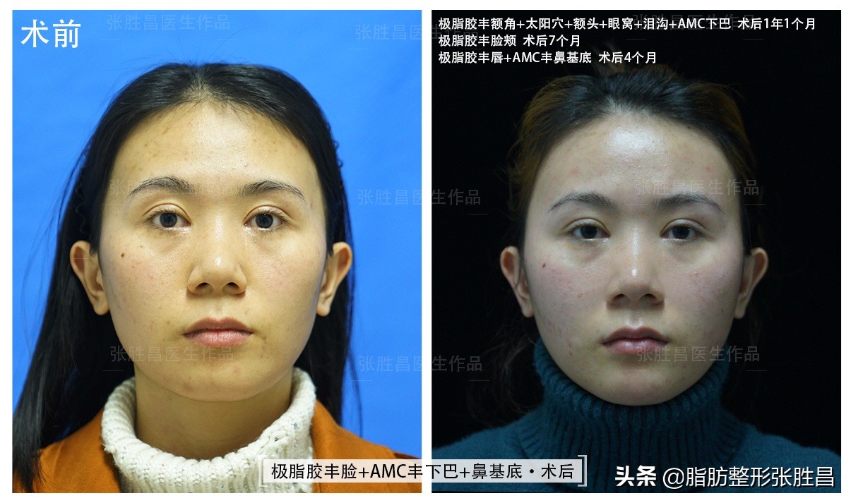 颧骨突出显凶怎么改善,脸凹显凶