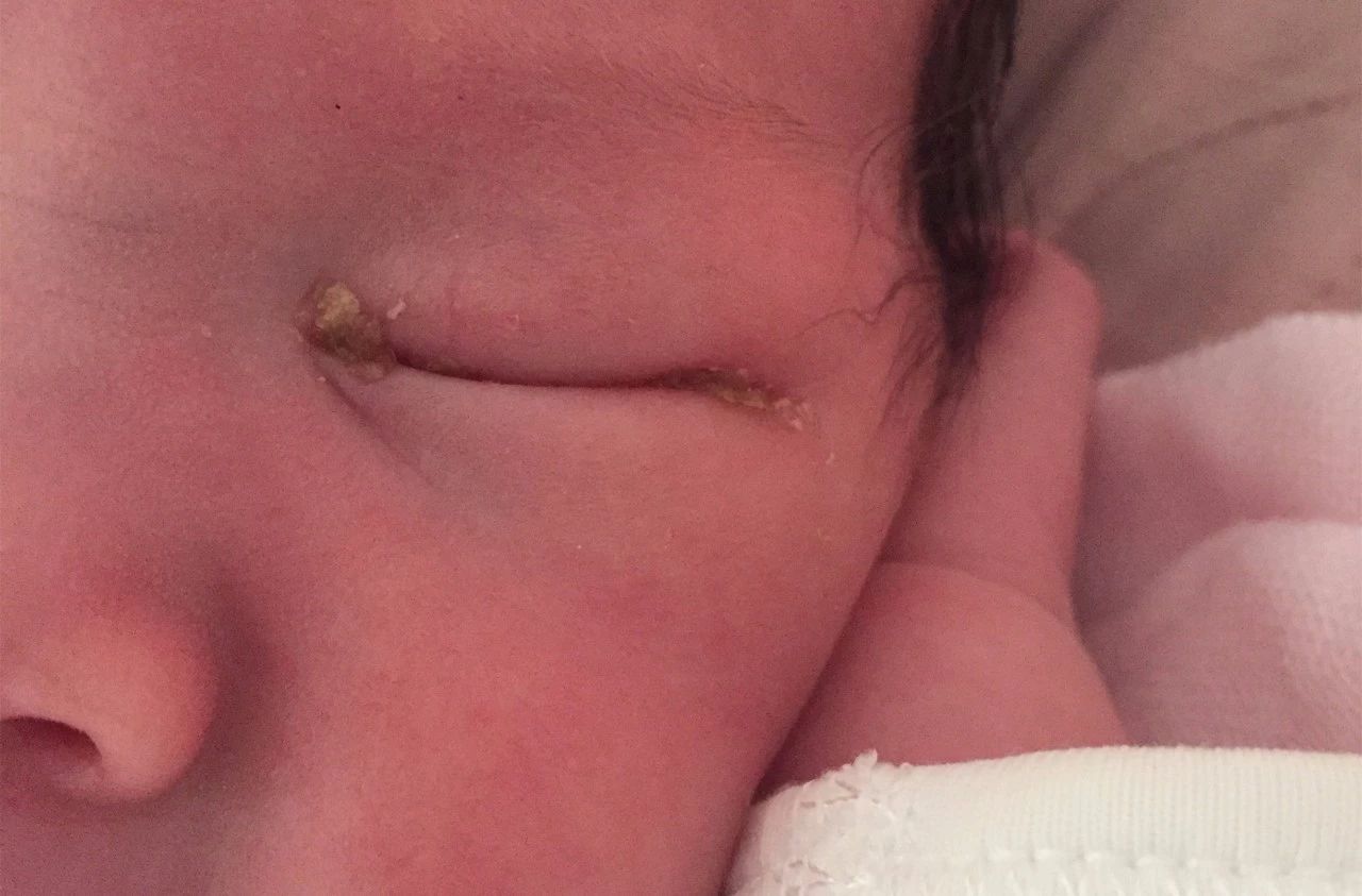 新生宝宝眼屎多什么原因,新生宝宝眼屎黄脓状怎么办