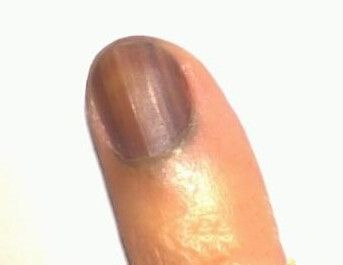 左手大拇指指甲上有褐色的竖纹,指甲上有竖纹代表有糖尿病吗