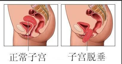 最近几天发现下面有块状物脱出,这是咋回事呢?