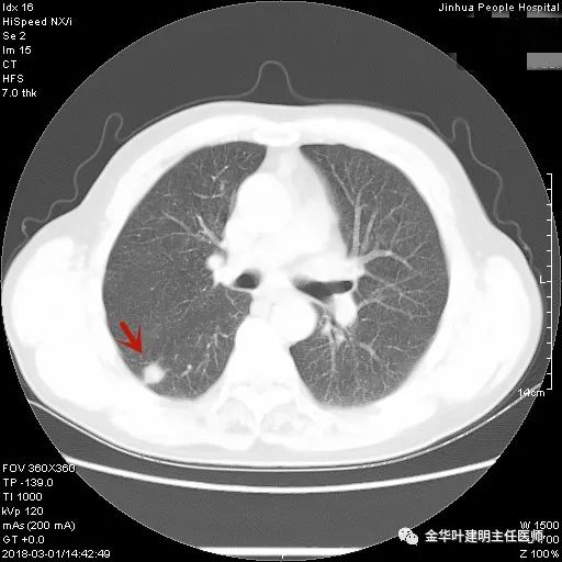 叶建明谈胸膜下的实性结节,叶建明肺实性良性结节会变癌症吗