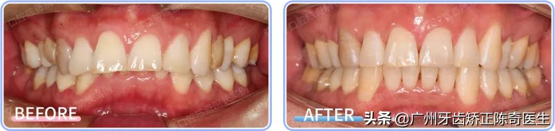 戴牙套会有下颌线,戴牙套的时候人会变丑吗