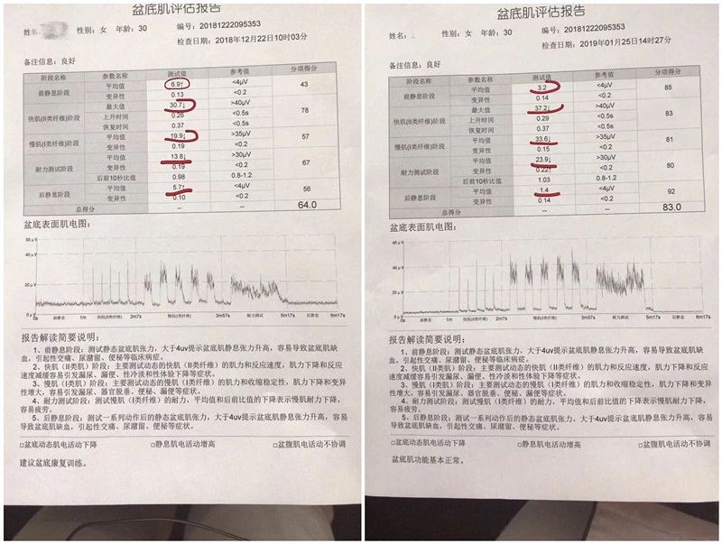 产后盆底肌修复案例,产后六七年盆底肌修复最简单动作