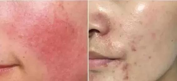 专治螨虫的洗面奶,螨虫专用洁面乳