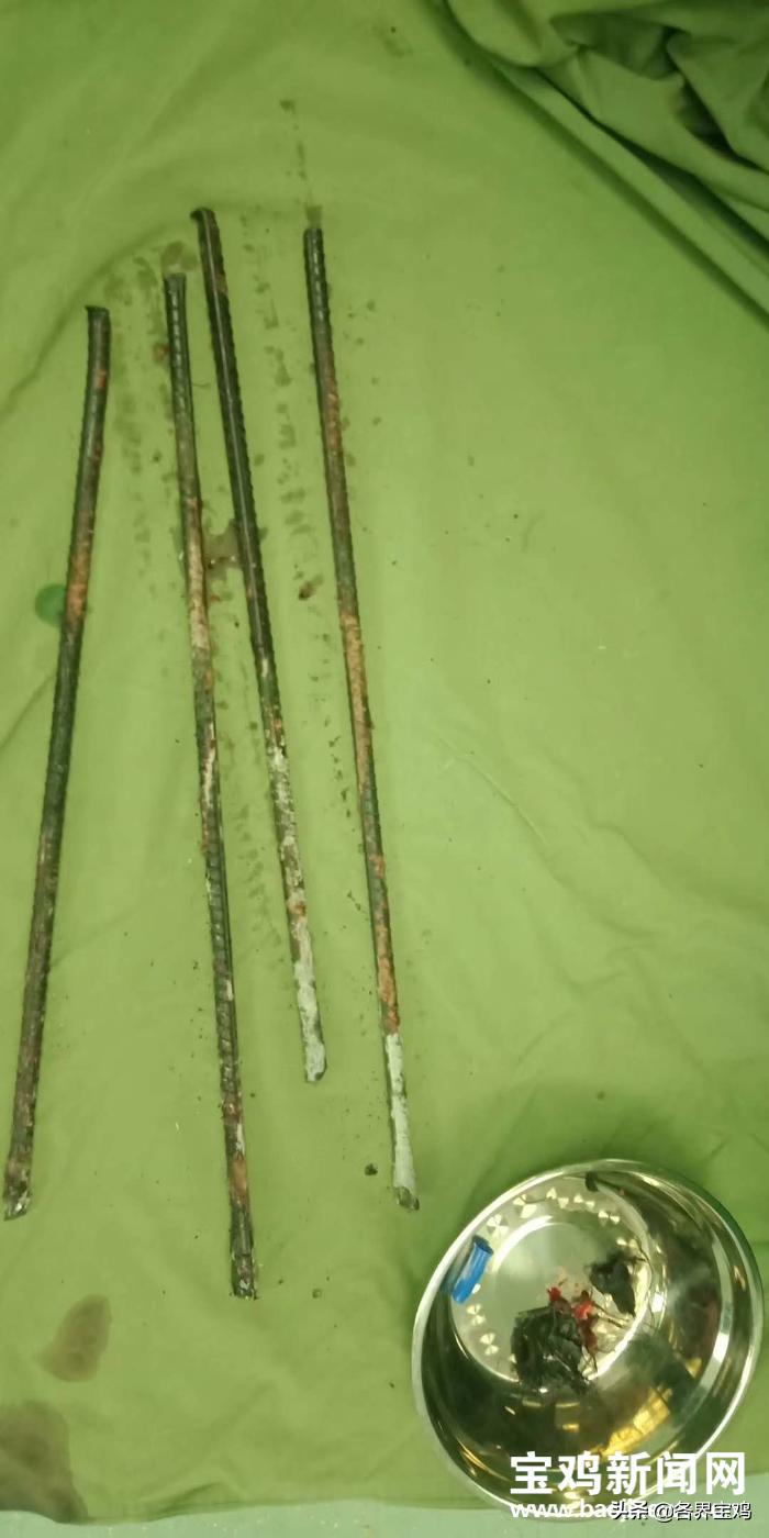三根钢筋贯穿农民工身体紧急抢救,多学科协作救治钢筋贯通伤患者