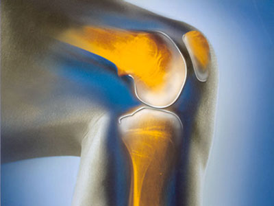 膝关节退变怎么办,膝关节易退化怎么办