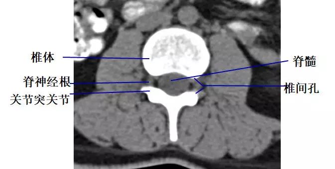 颈椎腰椎疾病ct及mri诊断,腰椎ct可以发现肠部病变吗