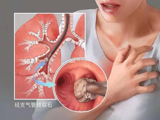 女子莫名咳嗽两年多结石竟长在支气管上哈医大一院群力院区多学科协作开展全麻下电子支气管镜取石