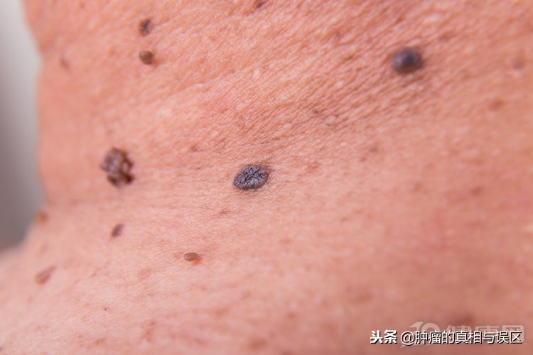 什么样的痣是皮肤癌的前兆,后期长出来的痣一定是皮肤癌吗