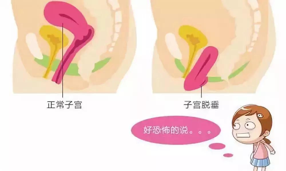 盆底功能障碍对女性有什么影响,女性盆底功能障碍