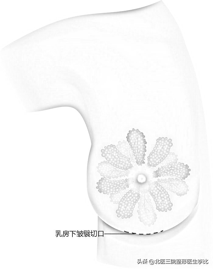 假体隆胸各种切口的优缺点,假体隆胸哪个切口最合适