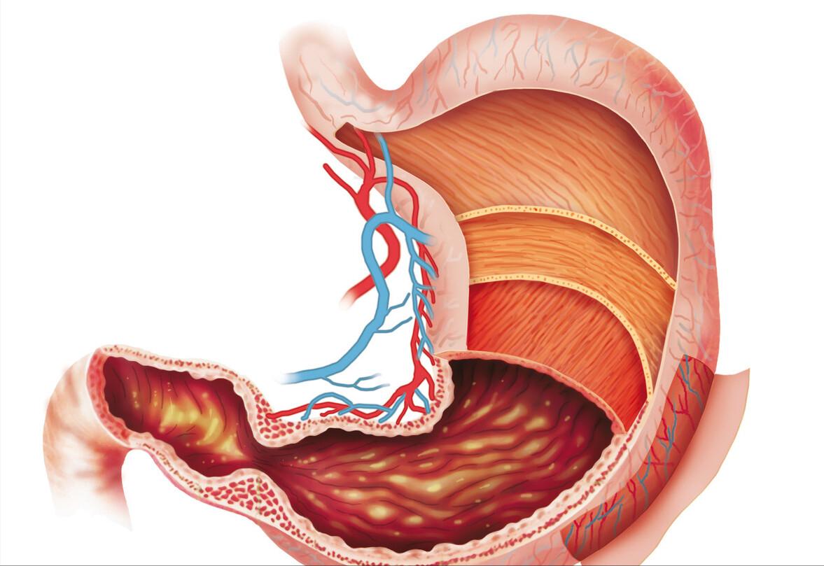 胃有湿气吃什么药能治疗,胃湿气重吃什么药好得快