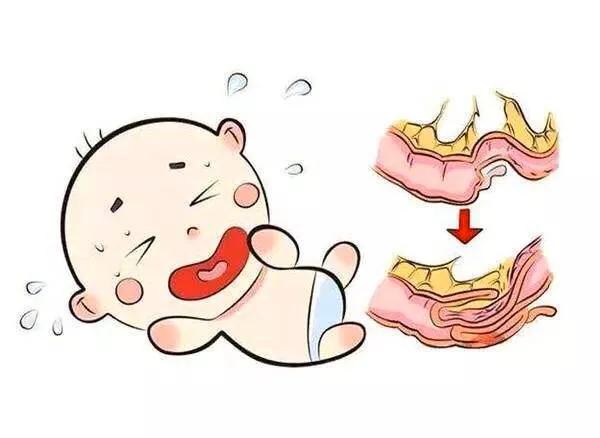 小儿肠套叠是什么原因发生的,小儿肠套叠有哪些症状表现