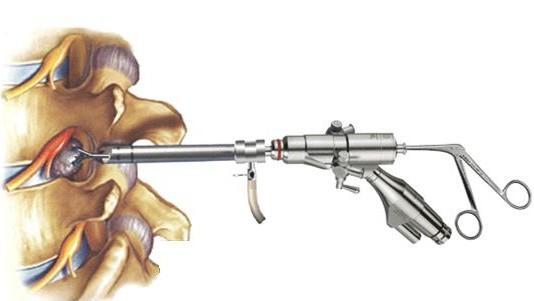 腰椎间盘突出针灸能治彻底吗,腰椎间盘突出针灸治疗能彻底吗