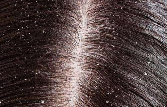 刚洗完头就有大量头皮屑怎么治,刚洗完头头皮屑很大块是什么原因