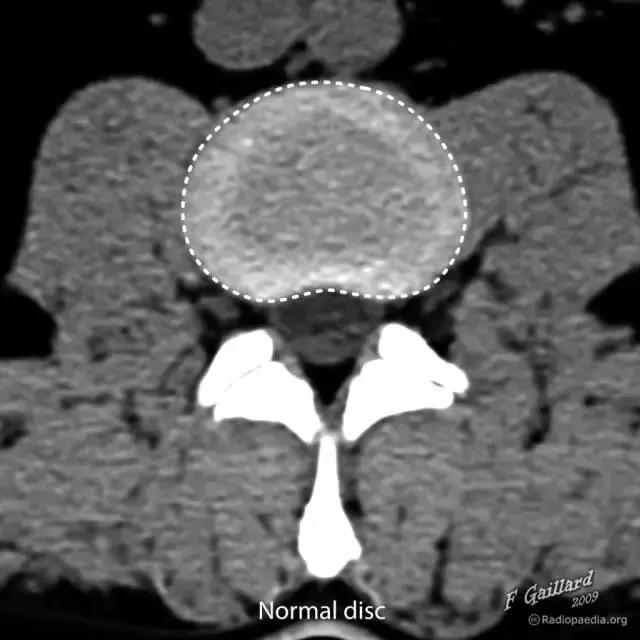 椎间盘脱出和突出片子怎么看,椎间盘膨出的鉴别诊断