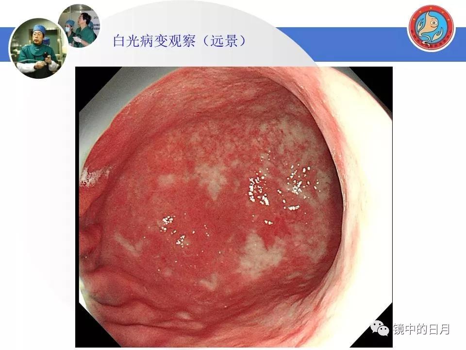 低分化胃癌早期时候做内镜手术吗,早期胃癌内镜手术后追加外科手术