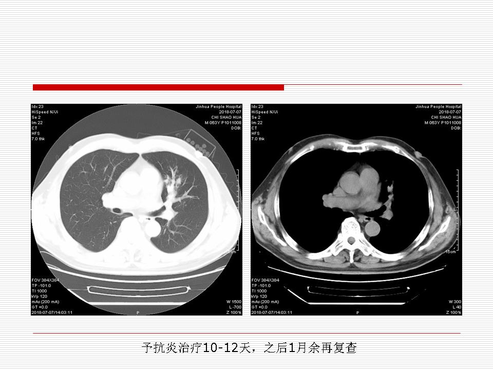 像炎症的肺癌能治好吗,医生说可能是肺癌也可能是炎症