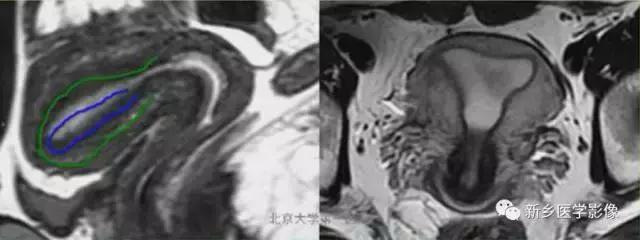 常见的几种子宫畸形诊断标准,先天性子宫畸形是什么原因造成的