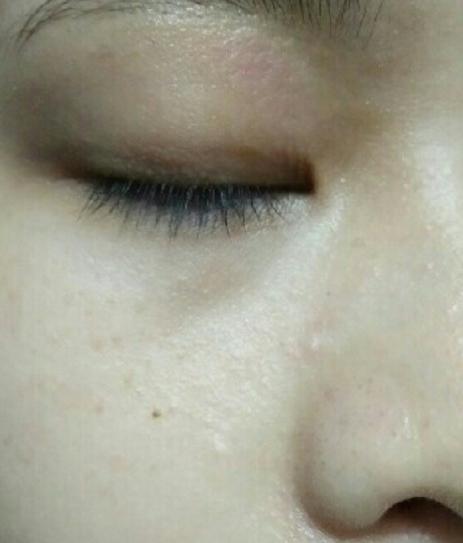 毛周角化中药调理治好了,重度汗管角化症最有效的治疗方法