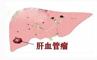 肝血管瘤的8个知识点,什么叫肝血管瘤严重吗