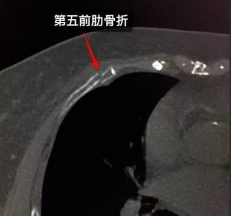 肋骨骨折三根保守治疗赔偿2万吗,肋骨骨折手术好还是保守治疗好