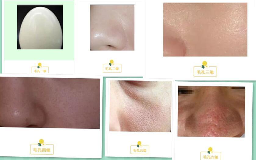 混干皮瑕疵皮毛孔粗大博主推荐,油皮瑕疵皮毛孔粗大