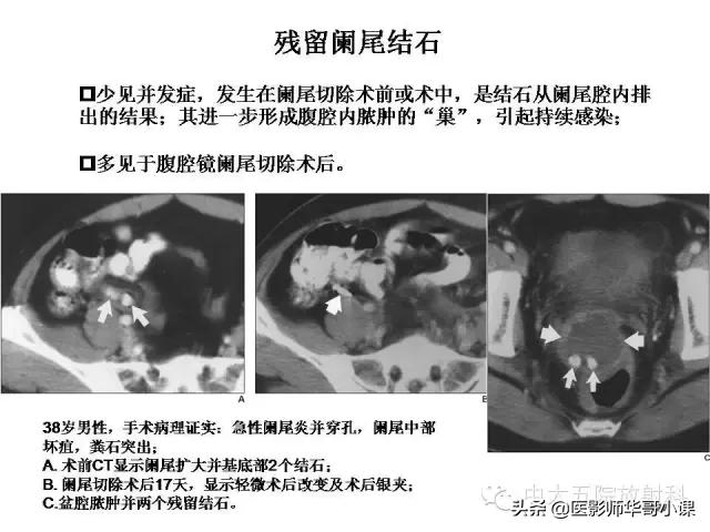 阑尾炎课件,阑尾炎的超声课件