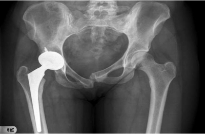 产后妈妈胯骨疼怎么回事,怀孕时耻骨痛产后还是痛怎么回事