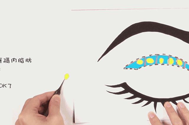 割双眼皮埋线和全切有什么区别,全切双眼皮内眼角割的不一样