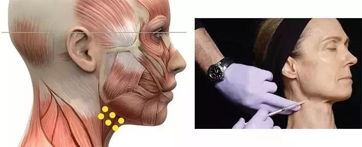 面肌痉挛右眼皮跳北京哪里治疗,眼皮一直抽搐跳动的原因面肌痉挛