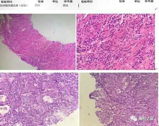 出院时，帅哥盯着费用清单哀叹：这个小真菌的棉被哟，真烧钱！
