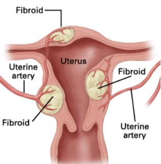 子宫肌瘤为什么会引发贫血,长了子宫肌瘤为什么容易长斑