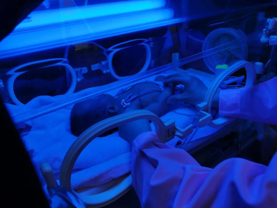 宝宝上午黄疸高下午减轻,黄疸早上高下午降