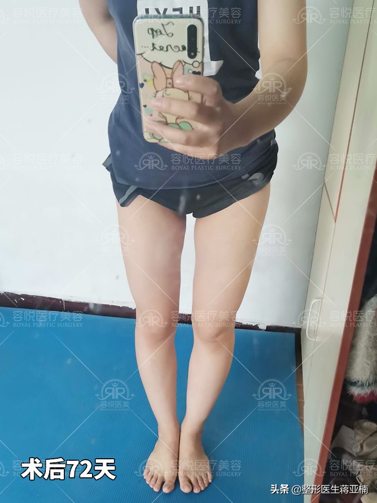 大腿吸脂后变胖,大腿吸脂拯救我的大粗腿