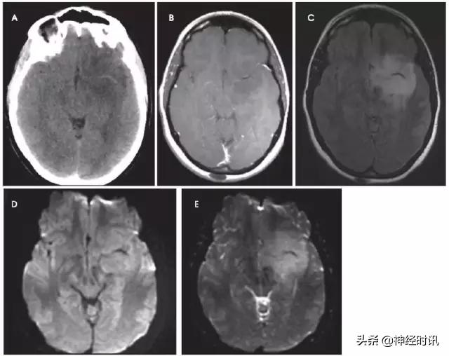 脑卒中病历诊断书图片,脑卒中影像判断技巧图解电子版