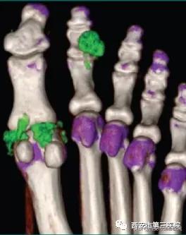 痛风影像技术,痛风石电镜