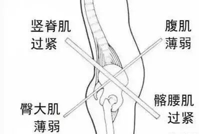 治疗骨盆前倾引起腰痛的锻炼方法,骨盆前倾腰疼纠正最快的方法
