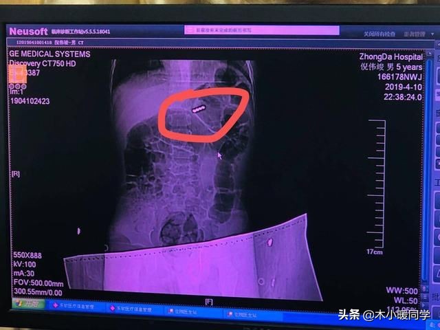 孩子误吞异物怎么办,孩子误吞异物