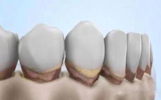 牙槽骨高了怎么做种植牙,牙槽骨少可以种植吗