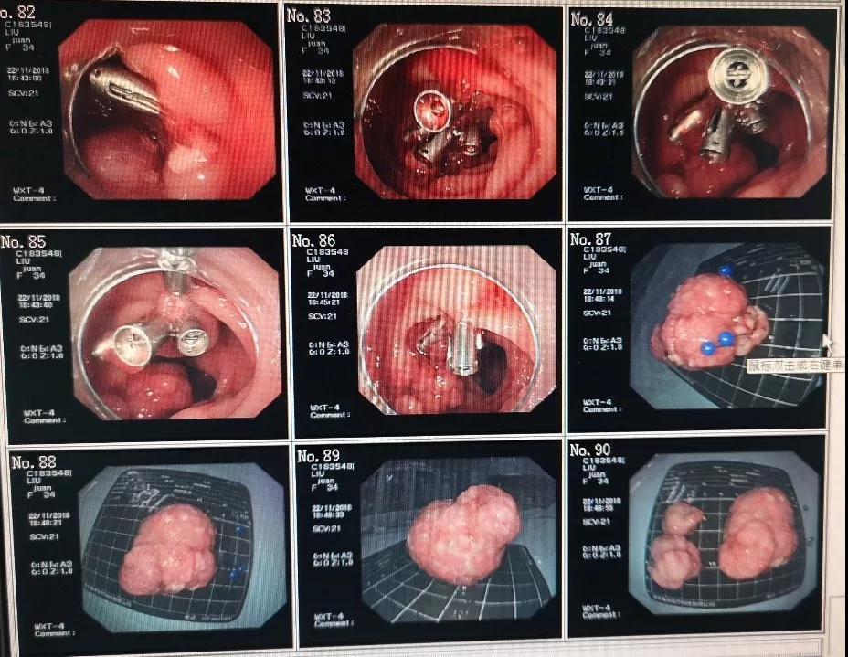 肠道息肉嘴唇黑斑,嘴唇上有黑点是肠道息肉吗