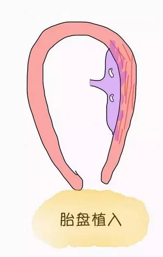 孕产｜发现“前置胎盘”怎么办？
