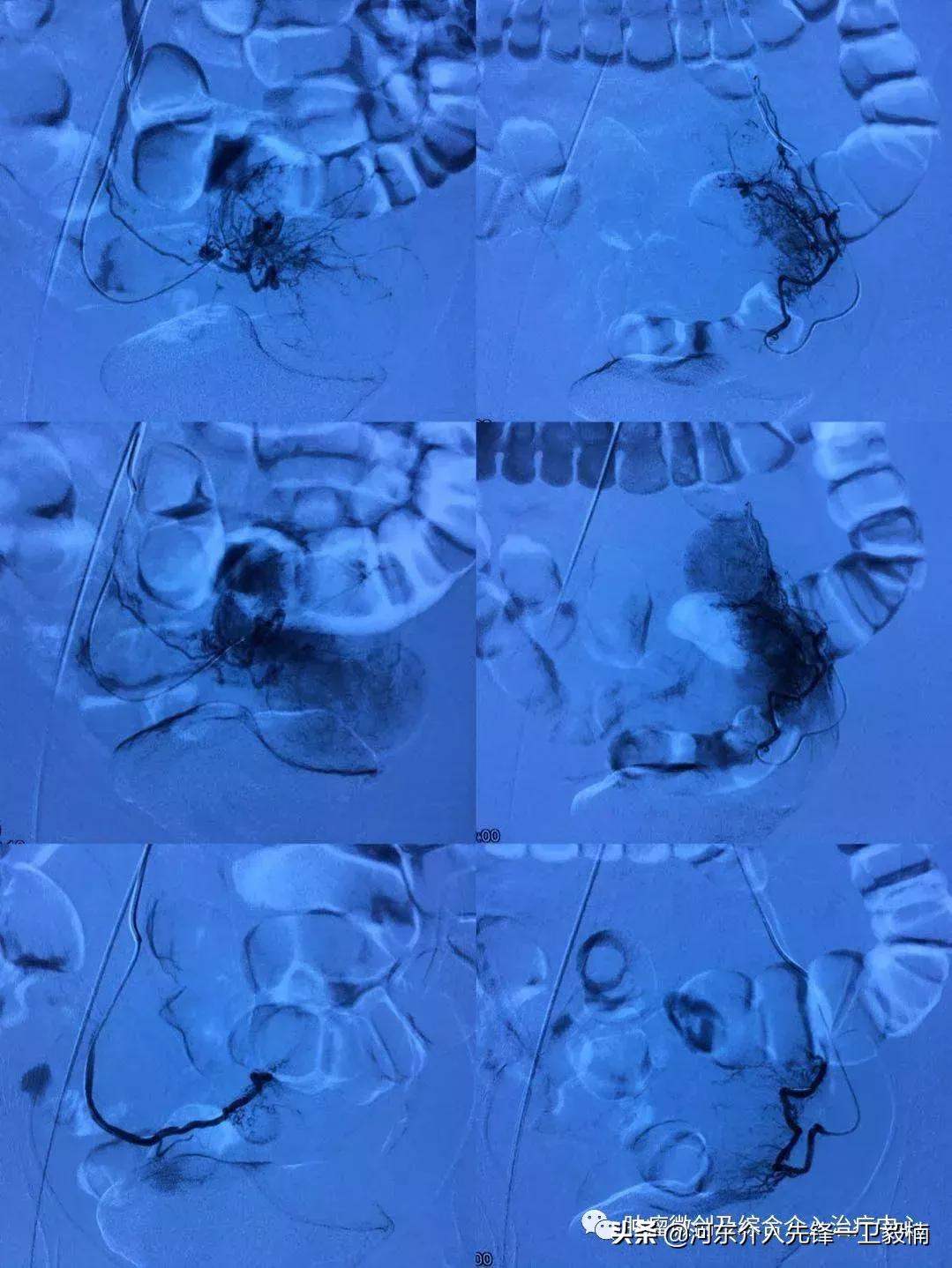 运城市第一医院肿瘤介入科,子宫肌瘤微创手术是超声介入吗