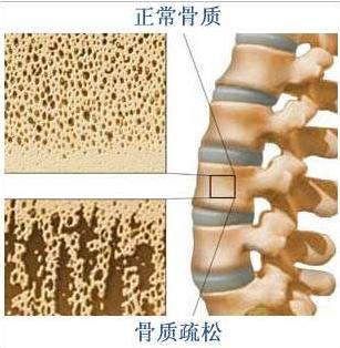 腰椎l4骨折保守治疗多久可以恢复,腰椎骨折手术还是保守治疗好