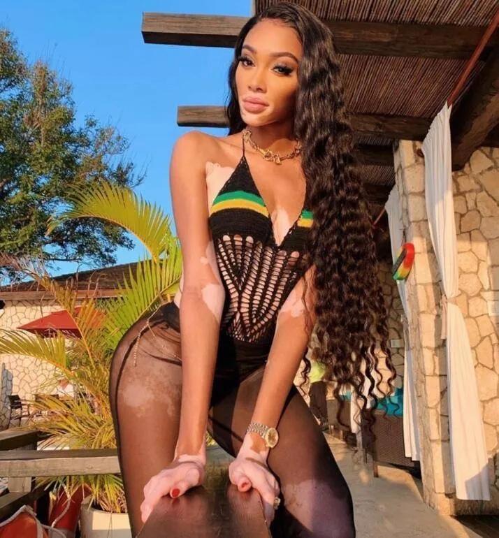 库兹马女朋友有白癜风会全白吗,库兹马与白癜风超模女友海边度假