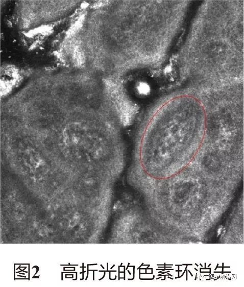皮肤共聚焦显微镜能查什么,皮肤镜和共聚焦显微镜