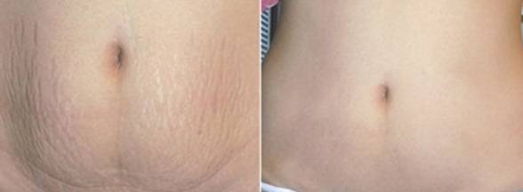 产后妊娠纹怎么去除,产后祛除妊娠纹最有效的方法